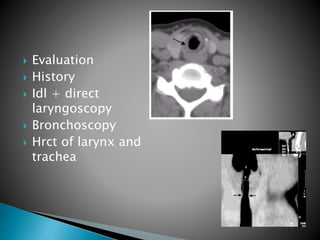  Evaluation
 History
 Idl + direct
laryngoscopy
 Bronchoscopy
 Hrct of larynx and
trachea
 