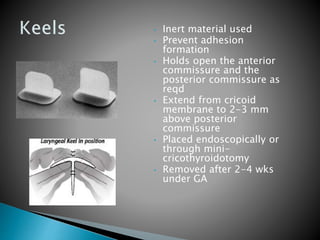 • Inert material used
• Prevent adhesion
formation
• Holds open the anterior
commissure and the
posterior commissure as
reqd
• Extend from cricoid
membrane to 2-3 mm
above posterior
commissure
• Placed endoscopically or
through mini-
cricothyroidotomy
• Removed after 2-4 wks
under GA
 