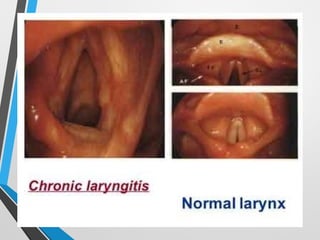 laryngitis-240114071958-1eb2f91final.ppt