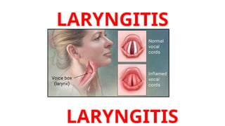 Laryngitis Persistent Comprehensive Overview of Laryngitis: Types, Symptoms, and Treatments ...