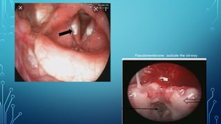 Pseudomembrane occlude the airway
 
