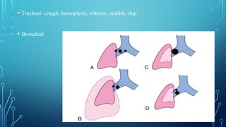 • Tracheal- cough, hemoptysis, wheeze, audible slap
• Bronchial
 