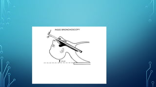 LARYNGITIS  and chronic inflammation ppt