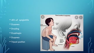 • 4D’s of epiglottitis
• Dyspnea
• Drooling
• Dysphagia
• Dyspnea
• Tripod position
 