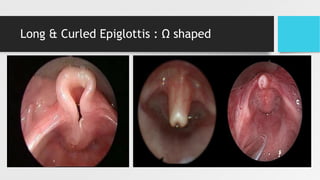 Long & Curled Epiglottis : Ω shaped
 
