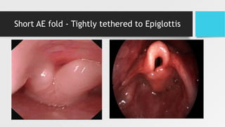 Short AE fold - Tightly tethered to Epiglottis
 