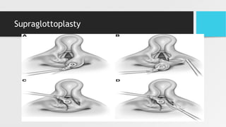 Supraglottoplasty
 