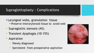 Supraglottoplasty : Complications
• Laryngeal webs, granulation tissue
• Preserve interarytenoid tissue to avoid web
• Supraglottic stenosis (4%)
• Transient dysphagia (10-15%)
• Aspiration
• ?Newly diagnosed
• ?persistent from preoperative aspiration
 