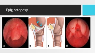 Epiglottopexy
 