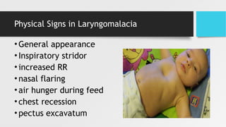 Physical Signs in Laryngomalacia
•General appearance
•Inspiratory stridor
•increased RR
•nasal flaring
•air hunger during feed
•chest recession
•pectus excavatum
 