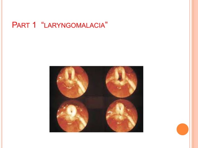 Laryngomalacia BY ZAINAB AHMED