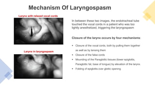 In between these two images, the endotracheal tube
touched the vocal cords in a patient who was too
lightly anesthetized, triggering the laryngospasm
Mechanism Of Laryngospasm
Closure of the larynx occurs by four mechanisms:
 Closure of the vocal cords, both by pulling them together
as well as by tensing them
 Closure of the false cords
 Mounding of the Paraglottic tissues (lower epiglottis,
Paraglottic fat, base of tongue) by elevation of the larynx.
 Folding of epiglottis over glottic opening
Larynx with relaxed vocal cords
Larynx in laryngospasm
 