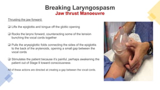 Thrusting the jaw forward:
 Lifts the epiglottis and tongue off the glottic opening
 Rocks the larynx forward, counteracting some of the tension
bunching the vocal cords together
 Pulls the aryepiglottic folds connecting the sides of the epiglottis
to the back of the arytenoids, opening a small gap between the
vocal cords
 Stimulates the patient because it’s painful, perhaps awakening the
patient out of Stage II toward consciousness
All of these actions are directed at creating a gap between the vocal cords.
Breaking Laryngospasm
Jaw thrust Manoeuvre
 