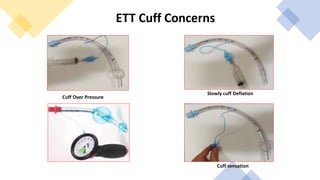 ETT Cuff Concerns
Cuff Over Pressure
Cuff sensation
Slowly cuff Deflation
 