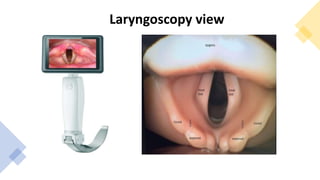 Laryngoscopy view
 