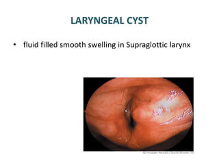 LARYNGEAL CYST
• fluid filled smooth swelling in Supraglottic larynx
 