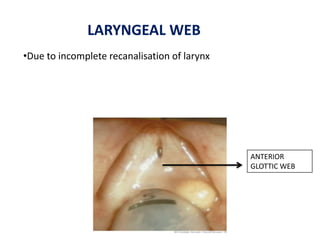 ANTERIOR
GLOTTIC WEB
•Due to incomplete recanalisation of larynx
LARYNGEAL WEB
 