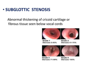 • SUBGLOTTIC STENOSIS
Abnormal thickening of cricoid cartilage or
fibrous tissue seen below vocal cords
 