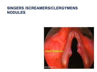 SINGERS /SCREAMERS/CLERGYMENS
NODULES
 