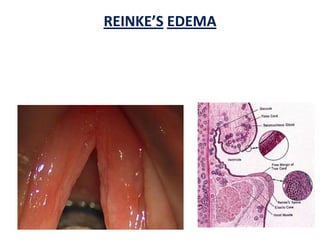REINKE’S EDEMA
 