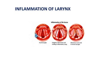 INFLAMMATION OF LARYNX
 