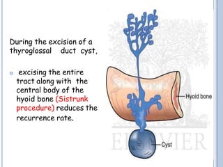 During the excision of a
thyroglossal duct cyst,
 excising the entire
tract along with the
central body of the
hyoid bone (Sistrunk
procedure) reduces the
recurrence rate.
 
