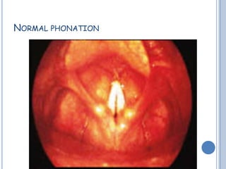 NORMAL PHONATION
 