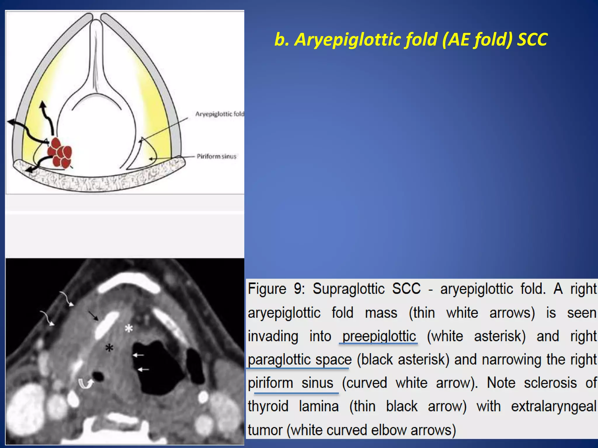 Larynx Anatomy And Laryngeal Ca PPTX larynx-anatomy-and-laryngeal-ca-pptx