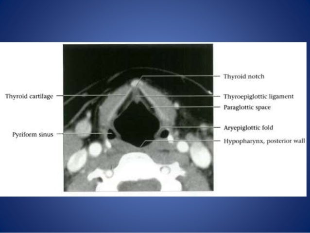 Larynx anatomy and laryngeal ca