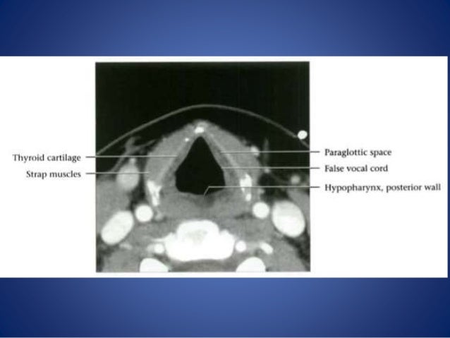 Larynx anatomy and laryngeal ca