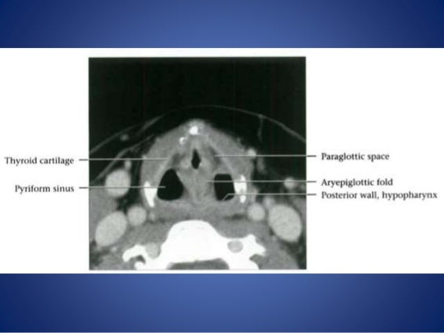 Larynx anatomy and laryngeal carcinoma