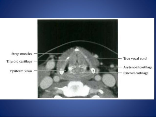 Larynx anatomy and laryngeal carcinoma