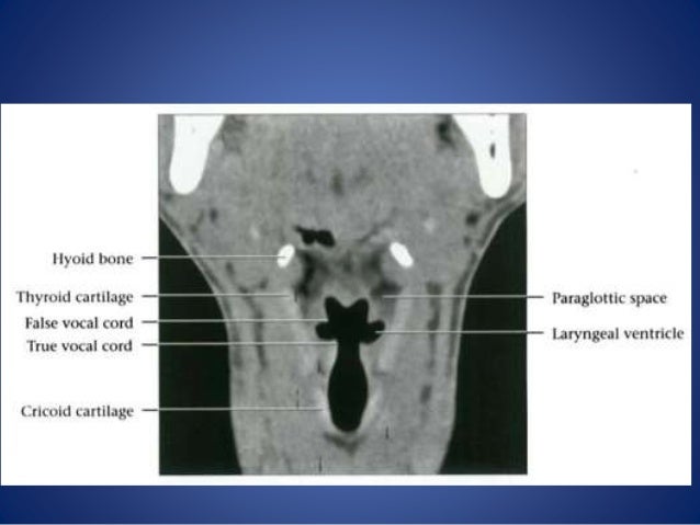 Larynx anatomy and laryngeal carcinoma