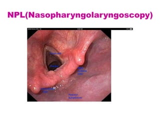 NPL(Nasopharyngolaryngoscopy)
 