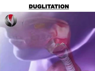 DUGLITATION
 