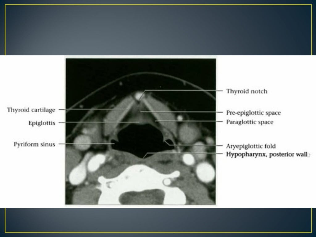 Larynx anatomy ct and mri