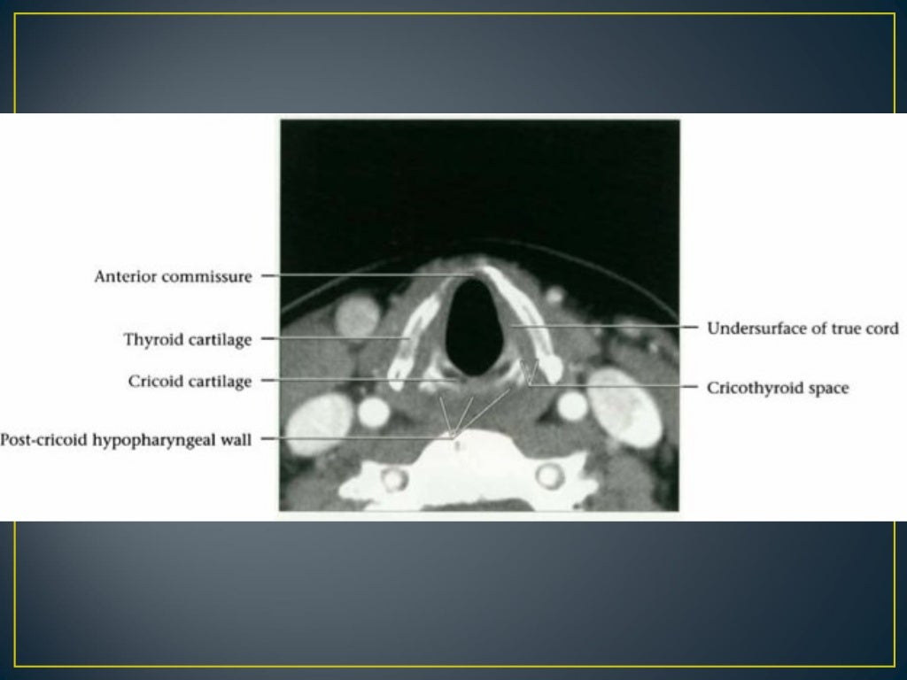 Larynx anatomy ct and mri