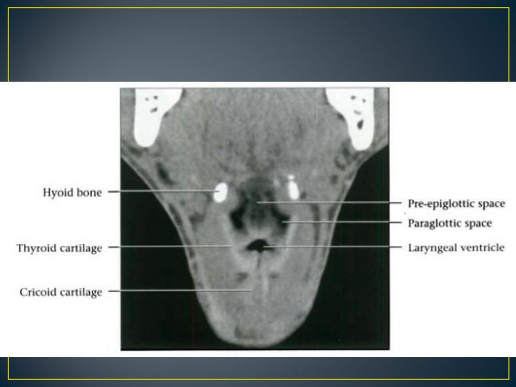 Larynx anatomy ct and mri