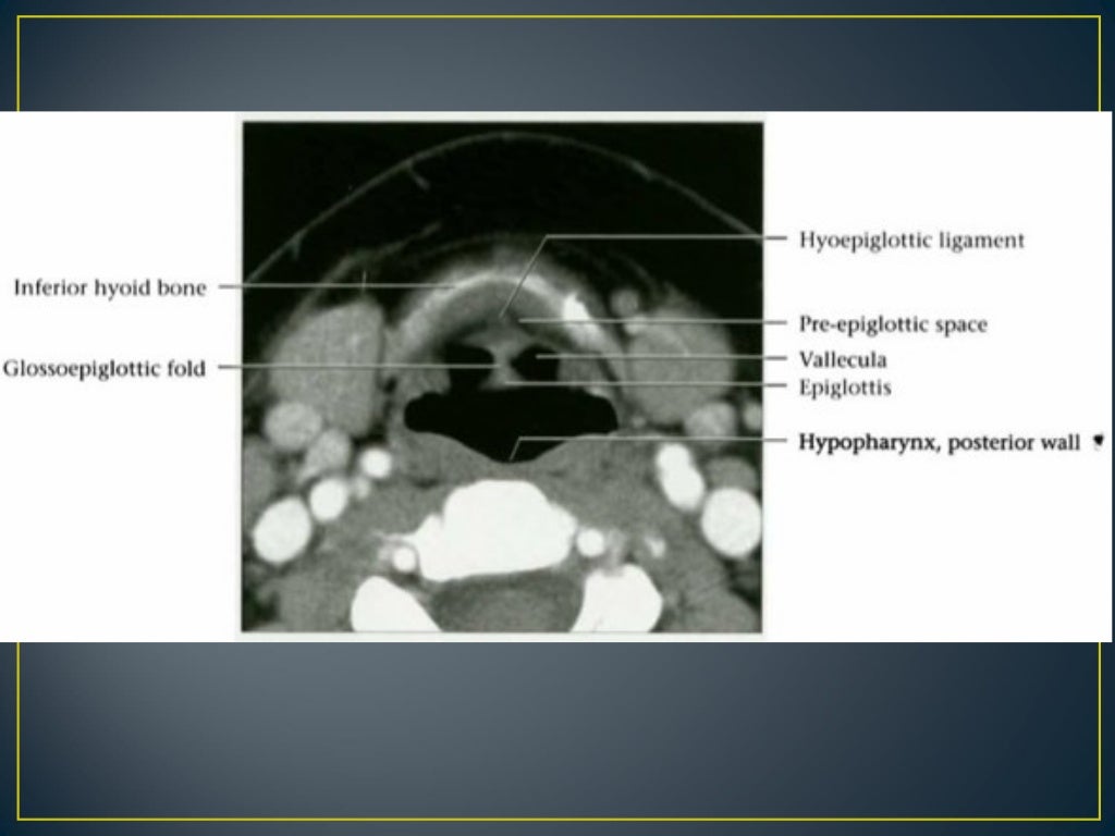 Larynx anatomy ct and mri