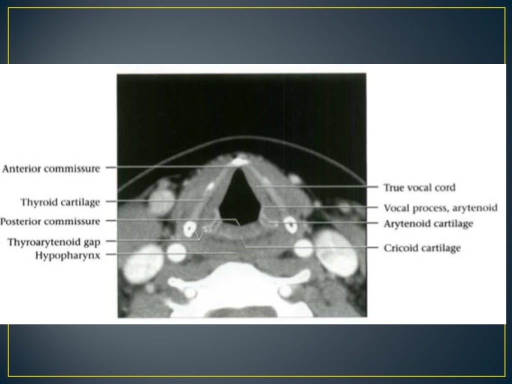 Larynx anatomy ct and mri