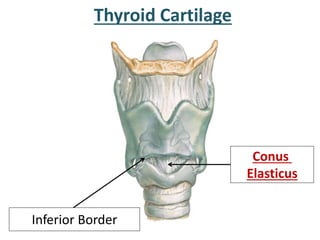 Thyroid Cartilage
Conus
Elasticus
Inferior Border
 