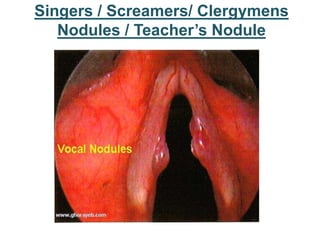 Singers / Screamers/ Clergymens
Nodules / Teacher’s Nodule
 