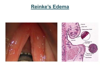 Reinke’s Edema
 