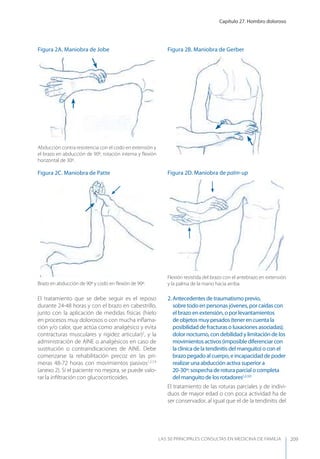Capítulo 27. Hombro doloroso
LAS 50 principALeS conSuLtAS en medicinA de fAmiLiA 209
El tratamiento que se debe seguir es el reposo
durante 24-48 horas y con el brazo en cabestrillo,
junto con la aplicación de medidas físicas (hielo
en procesos muy dolorosos o con mucha inﬂama-
ción y/o calor, que actúa como analgésico y evita
contracturas musculares y rigidez articular)2
, y la
administración de AINE o analgésicos en caso de
sustitución o contraindicaciones de AINE. Debe
comenzarse la rehabilitación precoz en las pri-
meras 48-72 horas con movimientos pasivos1,2,7,9
(anexo 2). Si el paciente no mejora, se puede valo-
rar la inﬁltración con glucocorticoides.
2. Antecedentes de traumatismo previo,
sobre todo en personas jóvenes, por caídas con
el brazo en extensión, o por levantamientos
de objetos muy pesados (tener en cuenta la
posibilidad de fracturas o luxaciones asociadas);
dolor nocturno, con debilidad y limitación de los
movimientos activos (imposible diferenciar con
la clínica de la tendinitis del manguito) o con el
brazo pegado al cuerpo, e incapacidad de poder
realizar una abducción activa superior a
20-30º: sospecha de rotura parcial o completa
del manguito de los rotadores1,2,3,9
El tratamiento de las roturas parciales y de indivi-
duos de mayor edad o con poca actividad ha de
ser conservador, al igual que el de la tendinitis del
Figura 2A. Maniobra de Jobe
Abducción contra resistencia con el codo en extensión y
el brazo en abducción de 90º, rotación interna y ﬂexión
horizontal de 30º.
Figura 2C. Maniobra de Patte
Brazo en abducción de 90º y codo en ﬂexión de 90º.
Figura 2D. Maniobra de palm-up
Flexión resistida del brazo con el antebrazo en extensión
y la palma de la mano hacia arriba.
Figura 2B. Maniobra de Gerber
 