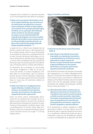 LAS 50 principALeS conSuLtAS en medicinA de fAmiLiA
Capítulo 27. Hombro doloroso
210
manguito de los rotadores. En pacientes jóvenes
o con una actividad física alta, debe ser quirúrgico.
3. Dolor en la cara anterior del hombro y en el
tercio superior del brazo, que aumenta con
los movimientos de abducción y rotación
externa del brazo; el dolor se desencadena
con la presión en la corredera bicipital (signo
di Palma), con la supinación del antebrazo
contra resistencia con el brazo pegado
al cuerpo y con el codo ﬂexionado 90º
(maniobra de yergason), así como al realizar
la ﬂexión del hombro contra resistencia con
el codo extendido (maniobra de palm-up
ﬁgura 2D): tendinitis del tendón largo del
bíceps (tendinitis bicipital)2,4,9,10,11
La aparición de un dolor brusco después de una
tracción violenta del brazo o del levantamiento
de un objeto pesado indica la rotura del bicipital.
Se acompaña de equimosis y desplazamiento de
la masa muscular del bíceps hacia abajo, con au-
mento del perímetro del brazo (signo de Popeye).
La rotura suele acompañarse de poca pérdida de
fuerza por seguir actuando la porción corta del bí-
ceps, el braquial anterior y el ﬂexor del antebrazo.
El tratamiento de la tendinitis es conservador,
con reposo, analgésicos o AINE. En el caso de
rotura del tendón, la actitud terapéutica tam-
bién debe ser conservadora, salvo en personas
jóvenes que por motivos laborales o deportivos
precisen un elevado requerimiento funcional del
brazo, en cuyo caso el tratamiento deberá ser
quirúrgico1,2,3,4,7,9
.
4. Dolor local intenso en la palpación de la
región deltoidea, irradiado al brazo y la
muñeca, con tumefacción por derrame
sinovial y con limitación en la abducción:
sospecha de bursitis subacromial
Existe una forma crónica, indistinguible clínica-
mente de una tendinitis del manguito de los ro-
tadores y que también se conoce como síndrome
del pinzamiento (impingement syndrome). El trata-
miento en la fase aguda es mediante reposo, hielo
y antiinﬂamatorios. En la fase crónica debe de ir
dirigido a reducir la compresión tendinosa, para lo
cual es necesario recurrir a la cirugía1,7,8,9
si no hay
mejoría clínica.
5. Otras formas de clínicas menos frecuentes
(tabla 2)
5.1. Dolor de gran intensidad de instauración
muy rápida, sin antecedentes traumáticos,
a menudo bilateral (en el 50% de los casos),
sobre todo en mujeres mayores de
40 años, con gran limitación de la movilidad
e hipersensibilidad en la cara anterior
del hombro y en el espacio subacromial:
sospecha de tendinitis calciﬁcante
Esta tendinitis se localiza casi siempre en el tendón
del supraespinoso y es visible radiográﬁcamente
(ﬁgura 3). El tratamiento se realiza con AINE, por vía
oral o intramuscular, y a menudo con inﬁltraciones
de glucocorticoides en la bolsa subacromial, sobre
todo en las crisis de hiperalgia. Siempre se debe
acompañar de medidas de ﬁsioterapia, medidas
físicas y ondas de choque1,2,3,7,8
.
5.2. Dolor de hombro difuso y continuo que no
deja dormir al paciente; con limitación de la
movilidad activa y pasiva en todos los planos,
y atroﬁa muscular secundaria, sobre todo si
ha existido una patología previa del hombro
que se ha seguido de una inmovilización
prolongada de la articulación: sospecha de
hombro congelado o capsulitis adhesiva
En el tratamiento se utilizan analgésicos o AINE
para reducir el dolor. Si no hay mejoría, con el ﬁn
de aliviar el dolor y mejorar el grado de movimien-
to, se emplearán inﬁltraciones locales de gluco-
corticoides y ejercicios de rehabilitación, pasivos
y activos, acompañados de la aplicación de ultra-
Figura 3. Tendinitis calciﬁcada
Izquierda
 