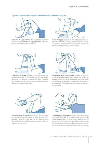Capítulo 29. Dolor de rodilla
LAS 50 principALeS conSuLtAS en medicinA de fAmiLiA 229
Figura 1. Exploración de la rodilla (modiﬁcado de la referencia 32) (cont.)
K. Maniobra de McMurray: posición en decúbito supi-
no con las piernas extendidas. Se pone la mano sobre
la rodilla y la interlínea articular, y se gira la pierna hasta
alcanzar la ﬂexión completa y provocar resalte o dolor. Se
exploran los meniscos.
L. Maniobra de Steinmann: posición en decúbito supino
con la rodilla ﬂexionada 90º. Se pone la mano sobre la rodilla
y la interlínea articular, y se gira la pierna. Si duele la interlínea
internadurantelarotaciónexterna,sedebesospecharrotura
de menisco interno; si duele en el lado externo durante la ro-
tacióninterna,hayquesospecharroturademeniscoexterno.
J. Prueba de distracción de Apley: posición en decúbito
prono con la rodilla ﬂexionada 90º, sujetando el muslo con
la rodilla. Se hace tracción de la rodilla, a la vez que se rota la
pierna.Laaparicióndedolorindicalesióndelosligamentoso
de la cápsula. Si sólo está lesionado el menisco, no hay dolor
enestaprueba.
I. Maniobra de Apley: posición en decúbito prono con
la rodilla ﬂexionada 90º. Se ejerce presión hacia abajo a la
vez que se rota la pierna. La aparición de dolor y chasqui-
do indica lesión en el menisco, interno o externo, según
el lado donde aparezca el dolor.
G. Prueba de cajón anterior (1): se explora el ligamento
cruzado anterior. Prueba de cajón posterior (2): se ex-
plora el ligamento cruzado posterior.
H. Test de Wipple: posición en decúbito prono con la ro-
dilla ﬂexionada 90º. Se empuja la tibia en sentido craneal,
y se observa desplazamiento hacia delante en caso de
afectación del ligamento cruzado posterior.
1
2
 