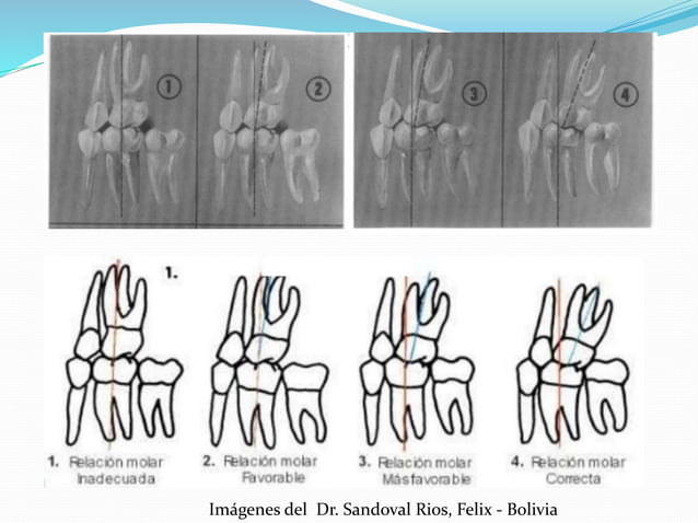 Llaves De La Oclusion De Andrews