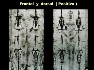 Frontal y dorsal ( Positivo )
 