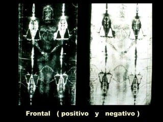 Frontal ( positivo y negativo )
 