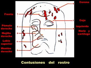 Contusiones del rostro
Frente
Pómulo
derecho
Mejilla
derecha
Labio
superior
Mentón
derecho
Corona
Ceja
izquierda
Nariz y
cartílago
 